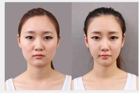 北京打瘦脸针后遗症