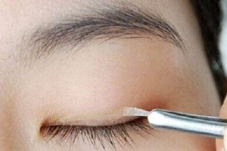 北京美莱做双眼皮的价钱